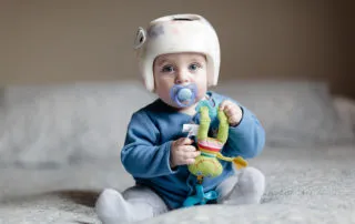 baby with flat head syndrome