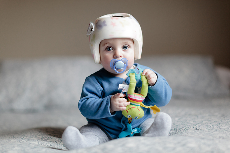 baby with flat head syndrome